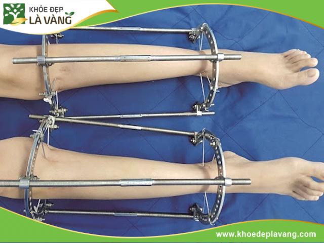 Phương pháp kéo dài chân gây đau đớn