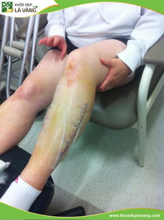 Sẹo để lại sau khi kéo dài chân
