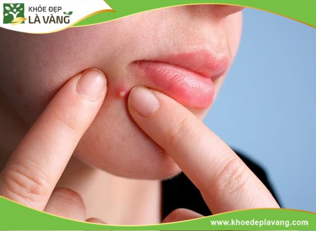 Da có thể nổi mụn bởi nhiều lý do, trong đó có nguyên nhân từ bánh mì