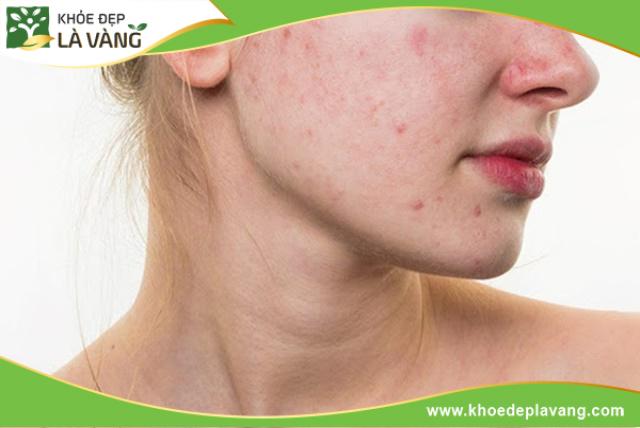 Mụn có thể xuất hiện do các lý do khác mà không phải vì ăn chuối