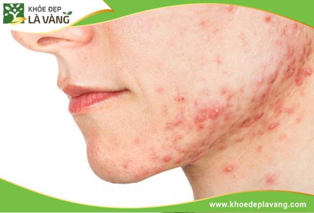 Ăn quá nhiều nhãn sẽ gây nóng người, da dễ bị nổi mụn