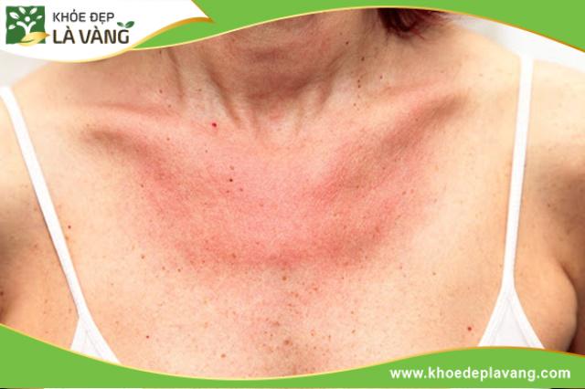 Ăn ớt quá nhiều có thể khiến da bị kích ứng