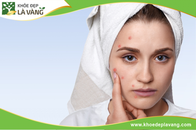 Ăn quá nhiều sầu riêng có thể dẫn đến nóng trong người, từ đó bị mụn