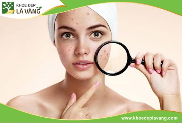 Nguyên nhân gây mụn trứng cá chủ yếu do các tác động từ môi trườngNguyên nhân gây mụn trứng cá chủ yếu do các tác động từ môi trường