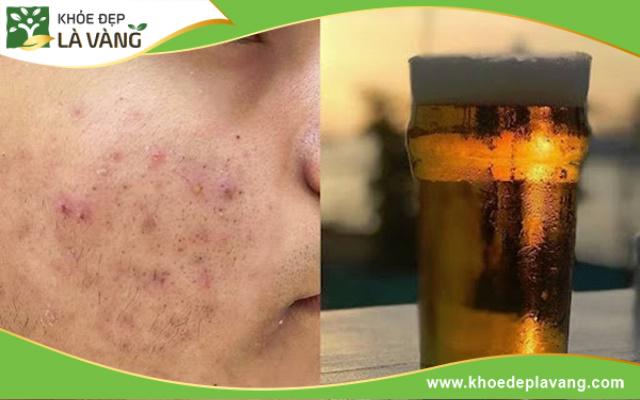 Bia gây mất cân bằng nội tiết, khô da, giảm miễn dịch,... tất cả đều dẫn đến tình trạng mụn