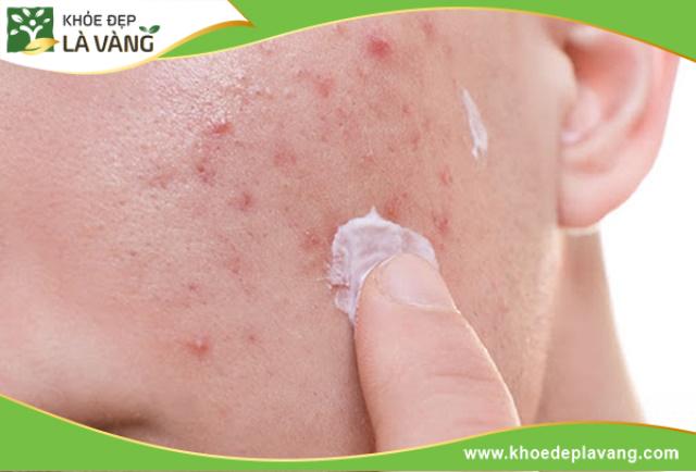 Sử dụng kem bôi trị mụn là cách cải thiện nhanh chóng và mang lại hiệu quả cao