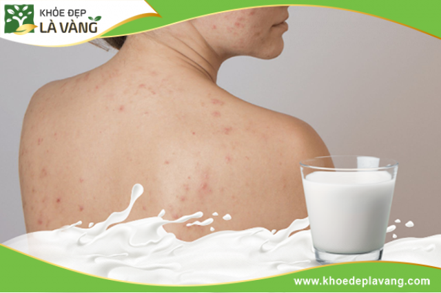 Uống nhiều sữa bò chứa IGF-1 hoặc hormone tăng trưởng có thể dẫn đến nổi mụn