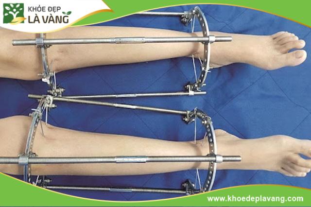 Phẫu thuật kéo dài chân có thể tăng chiều cao thêm 6-10cm