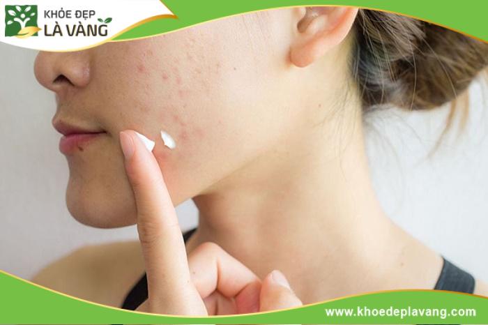 Một số loại thuốc có thể kiểm soát mụn tuổi dậy thì hiệu quả