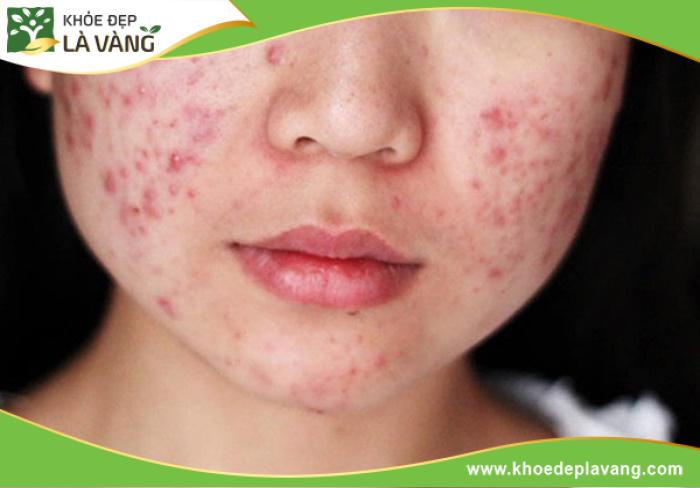 Mụn tuổi dậy thì là tình trạng da bị mọc mụn trong thời kỳ dậy thì